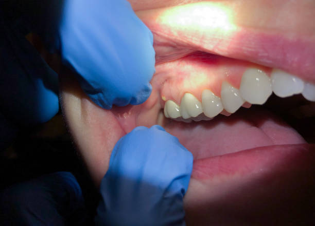 Best Emergency Tooth Extraction in Sandy Oaks, TX